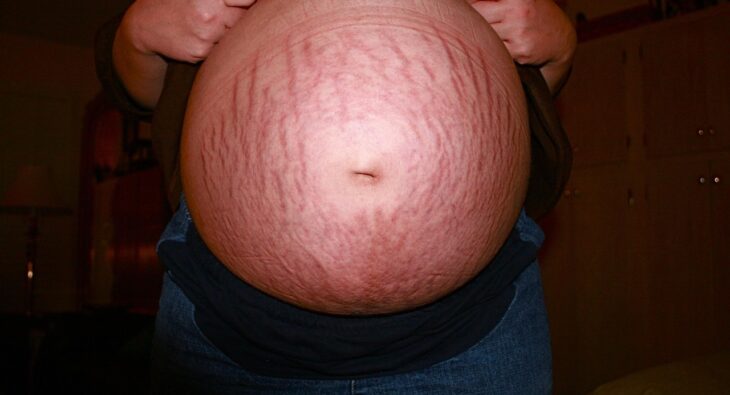 Jak Zminimalizować Rozstępy w Ciąży? Sekrety Wyboru Skutecznego Kremu!